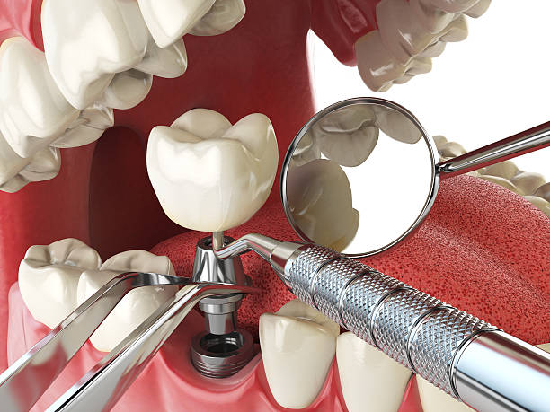 Best Knocked-Out Tooth (Avulsed Tooth) Treatment in Monrovia, MD